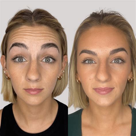 dysport before and after.